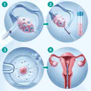مراحل انجام لقاح آزمایشگاهی و عمل IVF برای درمان ناباروری